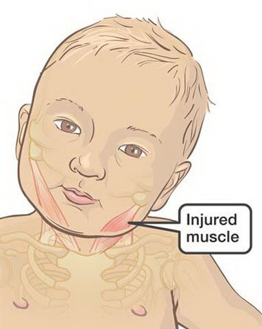 Baby Torticollis Treatment in Albany